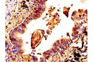 IHC image of ABIN7148983 diluted at 1:400 and staining in paraffin-embedded human lung cancer performed on a Leica BondTM system. (CSTA Antikörper  (AA 2-98))