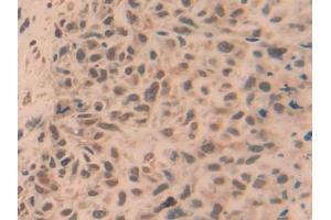 DAB staining on IHC-P; Samples: Human Lung cancer Tissue (TRAF5 Antikörper  (AA 181-437))