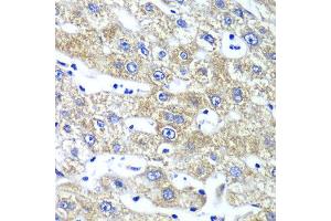 Immunohistochemistry of paraffin-embedded human liver injury using QARS antibody at dilution of 1:100 (x40 lens). (QARS Antikörper)