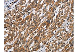 The image on the left is immunohistochemistry of paraffin-embedded Human esophagus cancer tissue using ABIN7190509(DSP Antibody) at dilution 1/40, on the right is treated with synthetic peptide. (Desmoplakin Antikörper)
