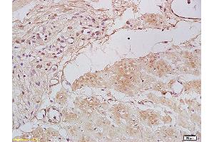 Formalin-fixed and paraffin embedded human gastric carcinoma labeled with Anti Tbx21/T-bet Polyclonal Antibody, Unconjugated (ABIN701395) at 1:200 followed by conjugation to the secondary antibody and DAB staining. (T-Bet Antikörper)