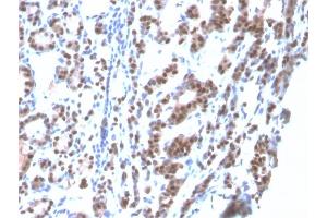 Formalin-fixed, paraffin-embedded human Thyroid stained with TTF-1 Mouse Recombinant Monoclonal Antibody (rNX2. (Rekombinanter NKX2-1 Antikörper)
