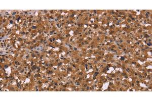Immunohistochemistry of paraffin-embedded Human thyroid cancer using HDLBP Polyclonal Antibody at dilution of 1:50
