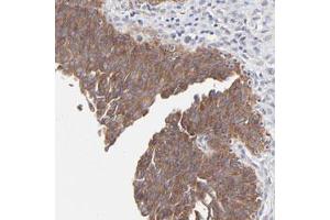 Immunohistochemical staining of human urinary bladder with PPFIBP2 polyclonal antibody  shows strong cytoplasmic positivity in urothelial cells at 1:50-1:200 dilution. (PPFIBP2 Antikörper)