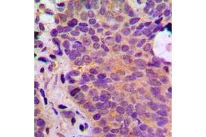 Immunohistochemical analysis of ADPGK staining in human breast cancer formalin fixed paraffin embedded tissue section. (ADPGK Antikörper  (Center))