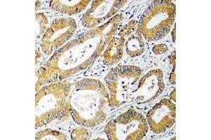 Immunohistochemical analysis of AGXT2L2 staining in human colon cancer formalin fixed paraffin embedded tissue section.