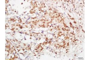 Formalin-fixed and paraffin embedded human lung carcinoma labeled with Rabbit Anti-B MyB Polyclonal Antibody, Unconjugated (ABIN760406) at 1:200 followed by conjugation to the secondary antibody and DAB staining (MYBL2 Antikörper  (AA 101-200))