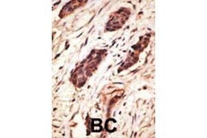 Formalin-fixed and paraffin-embedded human cancer tissue reacted with the primary antibody, which was peroxidase-conjugated to the secondary antibody, followed by DAB staining. (MMP10 Antikörper  (C-Term))