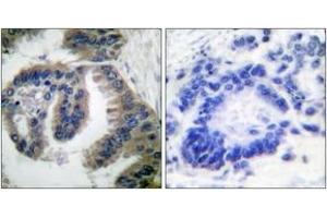 Immunohistochemistry analysis of paraffin-embedded human lung carcinoma tissue, using HSP40 Antibody.