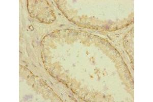 Immunohistochemistry of paraffin-embedded human prostate cancer using ABIN7167234 at dilution of 1:100