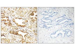 Immunohistochemistry analysis of paraffin-embedded human prostate carcinoma tissue, using CAMKK2 antibody. (CAMKK2 Antikörper  (Internal Region))