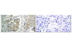 Immunohistochemical analysis of paraffin-embedded human breast carcinoma tissue, using V (VEGFR2/CD309 Antikörper  (pTyr1214))