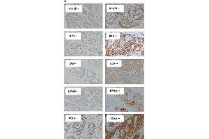 Immunostaining of EGFR ligands and co-expression with wtEGFR in mCRC specimensExpression of Amphiregulin, BTC, EGF, Epigen, and TGFα (A), and co-expression of wtEGFR, Amphiregulin, BTC, EGF, epigen, and TGFα in a particular patient (B) in formalin fixed paraffin embedded tumour sections stained immunohistochemically as described under methods and patients section. (Amphiregulin Antikörper)
