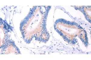 Immunohistochemistry of paraffin-embedded Human colon cancer using AADAC Polyclonal Antibody at dilution of 1:30 (AADAC Antikörper)