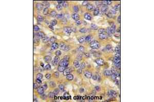 Formalin-fixed and paraffin-embedded human breast carcinoma tissue reacted with DKK3 Antibody (N-term), which was peroxidase-conjugated to the secondary antibody, followed by DAB staining.