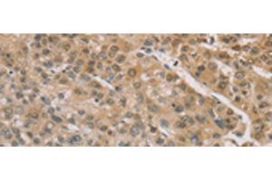 Immunohistochemistry of paraffin-embedded Human liver cancer tissue using ZIC2 Polyclonal Antibody at dilution of 1:100(x200)