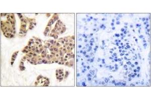 Immunohistochemistry analysis of paraffin-embedded human breast carcinoma, using BAD (Phospho-Ser91/128) Antibody. (BAD Antikörper  (pSer91))