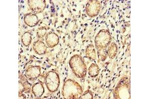 Immunohistochemistry of paraffin-embedded human gastric cancer using ABIN7160084 at dilution of 1:100 (BUB1 Antikörper  (AA 256-577))