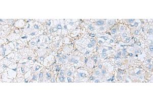 Immunohistochemistry of paraffin-embedded Human liver cancer tissue using EMILIN1 Polyclonal Antibody at dilution of 1:70(x200)