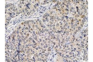 SQSTM1/p62 Mouse Monoclonal Antibody at 1/100 staining human lung cancer by IHC-P. (SQSTM1 Antikörper  (C-Term))