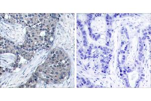 P-Peptide - +Immunohistochemical analysis of paraffin-embedded human breast carcinoma tissue using elF4E (phospho- Ser209) antibody. (EIF4E Antikörper  (pSer209))