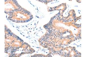 The image on the left is immunohistochemistry of paraffin-embedded Human colon cancer tissue using ABIN7128444(AOC1 Antibody) at dilution 1/15, on the right is treated with fusion protein. (DAO Antikörper)