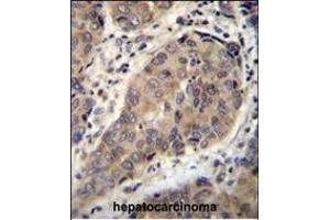 WTIP Antibody (C-term) (ABIN655782 and ABIN2845217) immunohistochemistry analysis in formalin fixed and paraffin embedded human hepatocarcinoma followed by peroxidase conjugation of the secondary antibody and DAB staining. (WTIP Antikörper  (AA 243-271))