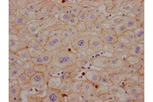 IHC image of ABIN7127422 diluted at 1:100 and staining in paraffin-embedded human liver cancer performed on a Leica BondTM system. (Rekombinanter CEACAM1 Antikörper)