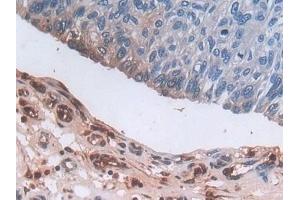 Detection of DEFa3 in Human Prostate cancer Tissue using Polyclonal Antibody to Defensin Alpha 3, Neutrophil Specific (DEFa3) (DEFa3 Antikörper  (AA 21-94))