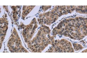Immunohistochemistry of paraffin-embedded Human breast cancer tissue using IPO8 Polyclonal Antibody at dilution 1:50 (Importin 8 Antikörper)