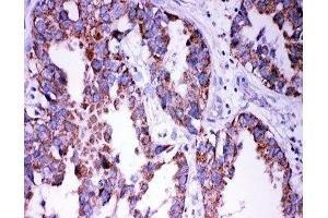 IHC-P: DISC1 antibody testing of human lung cancer tissue (DISC1 Antikörper  (Middle Region))