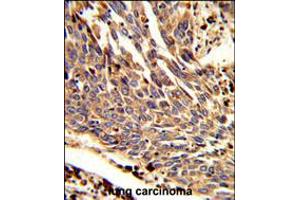 Formalin-fixed and paraffin-embedded human lung carcinoma reacted with ARPC1B Antibody , which was peroxidase-conjugated to the secondary antibody, followed by DAB staining.