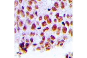 Immunohistochemical analysis of MSH2 staining in human breast cancer formalin fixed paraffin embedded tissue section. (MSH2 Antikörper)