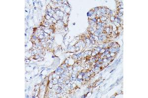 Immunohistochemistry of paraffin-embedded human colon carcinoma using MANBA antibody (ABIN7268392) at dilution of 1:100 (40x lens). (MANBA Antikörper  (AA 18-300))