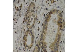 Immunohistochemistry of paraffin-embedded human stomach cancer using MAGEA1 antibody at dilution of 1:200 (400x lens). (MAGEA1 Antikörper)