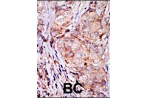 Formalin-fixed and paraffin-embedded human cancer tissue reacted with the primary antibody, which was peroxidase-conjugated to the secondary antibody, followed by AEC staining. (TRIB3 Antikörper  (N-Term))