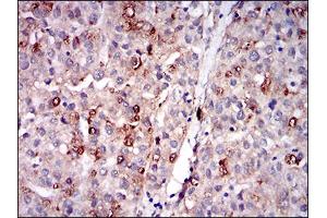 Immunohistochemical analysis of paraffin-embedded liver cancer tissues using PLIN2 mouse mAb with DAB staining. (ADRP Antikörper  (AA 286-437))