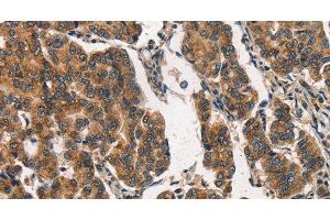 Immunohistochemistry of paraffin-embedded Human breast cancer using ITGA2 Polyclonal Antibody at dilution of 1:30 (ITGA2 Antikörper)