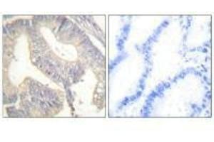 Immunohistochemical analysis of paraffin-embedded human colon carcinoma tissue using Gastrin antibody.
