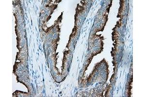 Immunohistochemical staining of paraffin-embedded Carcinoma of liver tissue using anti-PRKAR2A mouse monoclonal antibody. (PRKAR2A Antikörper)