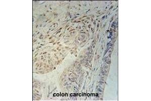 CCD92 Antibody (Center) (ABIN651208 and ABIN2840130) immunohistochemistry analysis in formalin fixed and paraffin embedded human colon carcinoma followed by peroxidase conjugation of the secondary antibody and DAB staining. (CCDC92 Antikörper  (AA 177-205))
