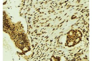 ABIN6274464 at 1/100 staining Human breast cancer tissue by IHC-P. (BRF1 Antikörper  (Internal Region))