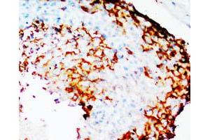Immunohistochemical staining of PTGS2 on formalin fixed, paraffin embedded human mammary cancer with PTGS2 polyclonal antibody . (PTGS2 Antikörper  (N-Term))