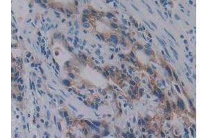 Detection of PKBb in Human Stomach cancer Tissue using Polyclonal Antibody to Protein Kinase B Beta (PKBb) (AKT2 Antikörper  (AA 142-412))