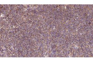 ABIN6273113 at 1/100 staining Human lymph cancer tissue by IHC-P.