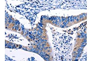 The image on the left is immunohistochemistry of paraffin-embedded Human colon cancer tissue using ABIN7193124(Gjc3 Antibody) at dilution 1/10, on the right is treated with synthetic peptide. (GJC3 Antikörper)