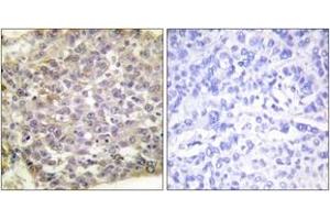 Immunohistochemistry analysis of paraffin-embedded human breast carcinoma tissue, using 14-3-3 zeta (Ab-58) Antibody. (14-3-3 zeta Antikörper  (AA 24-73))
