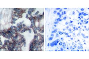 Peptide - +Immunohistochemical analysis of paraffin-embedded human breast carcinoma tissue using Claudin 1 antibody (#C0142). (Claudin 1 Antikörper)