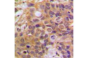 Immunohistochemical analysis of DAXX staining in human breast cancer formalin fixed paraffin embedded tissue section. (DAXX Antikörper  (Center))