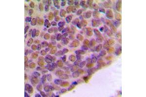 Immunohistochemical analysis of BRCA1 staining in human breast cancer formalin fixed paraffin embedded tissue section. (BRCA1 Antikörper  (C-Term))